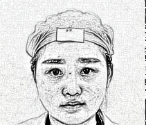 杭州格莱美张霞飞医师眼部综合、面部吸脂_介绍分享
