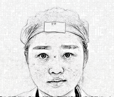 杭州格莱美张霞飞医师眼部综合、面部吸脂_介绍分享