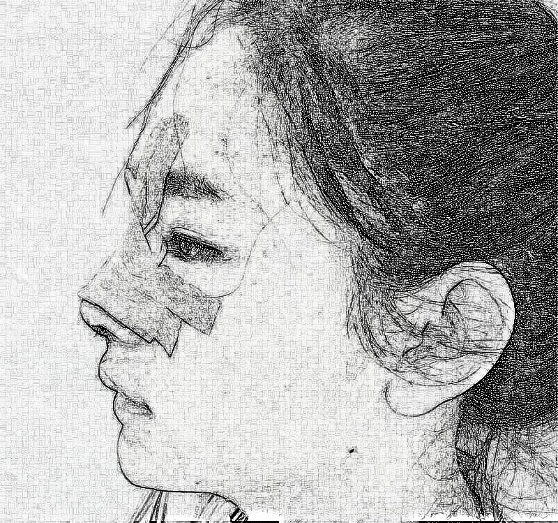 杭州格莱美金凤茹医师鼻部整形介绍 前后