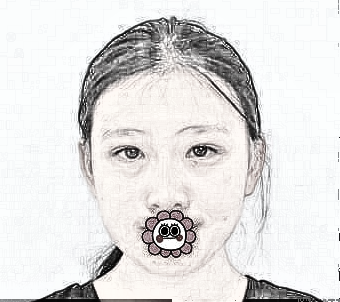 成都米兰魏家宾医师隆鼻介绍 前后