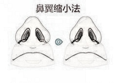 北京鼻翼缩小整形多少钱