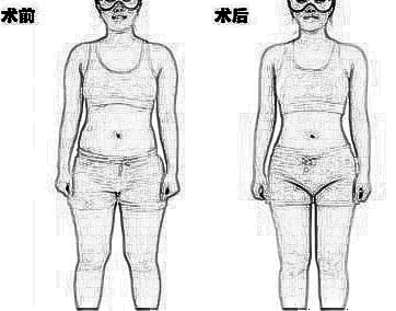 全身吸脂得多少钱 分几次完成