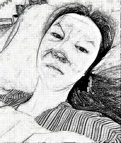 美国容丽妍许红丽为我做的鼻子 术后60天隆鼻介绍分享