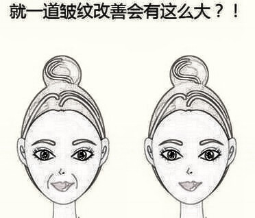 哈尔滨唯医注射胶原蛋白填充泪沟的原理