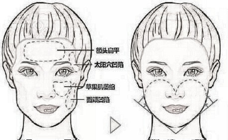 哈尔滨唯医注射胶原蛋白填充泪沟的原理