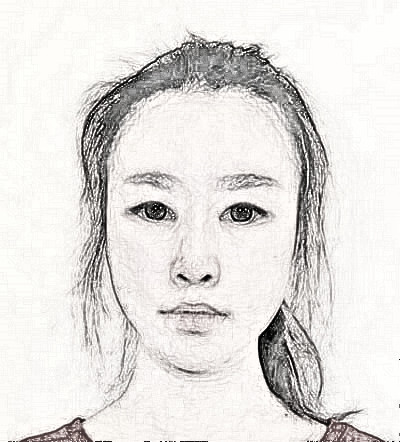 温州和平整形医院做的双眼皮怎么样？介绍术后果分享