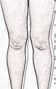 天津维美医疗美容做的吸脂瘦大腿怎么样？来看看术后3个月果