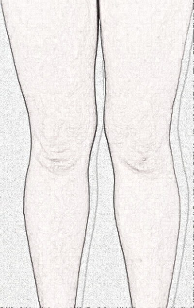 天津维美医疗美容做的吸脂瘦大腿怎么样？来看看术后3个月果