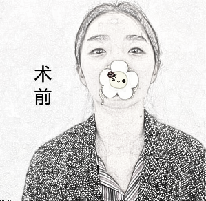 整形医院眼部手术怎么样？眼部整形术后前后果分享