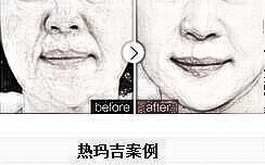 淮北天煌热玛吉紧肤除皱没问题吗