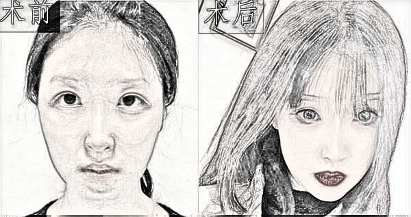 宁波静港整形自体脂肪面部填充介绍分享,附上