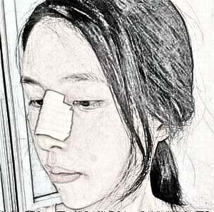 武汉欧尚美的王大山做的鼻部手术果怎么样?术后介绍分享