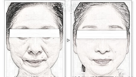 面部松弛彰显衰老 热玛吉挑战衰老极限