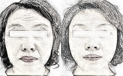 热玛吉除皱的果是长期的吗 调节时间长吗
