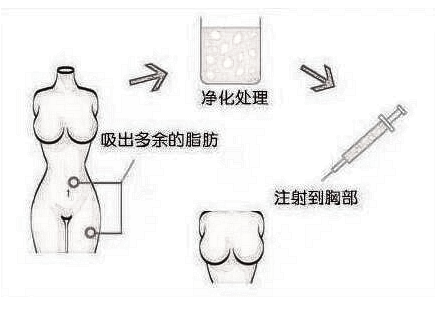 上海九院罗旭自体脂肪隆胸怎么样？