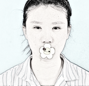 上海美联臣整形医院眼部手术+鼻部手术介绍分享，附果照公布