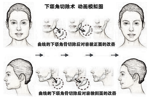 上海丽宣下颌角整形能瘦脸吗