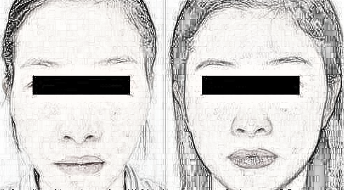 北京泽尔丽格自体脂肪填充太阳穴需要几次