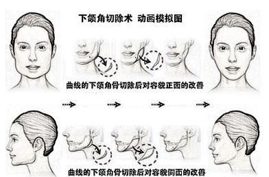 上海时光整形医院可以做磨骨吗 变瓜子脸怎么样