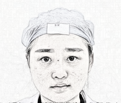 杭州格莱美张霞飞医师双眼皮+隆鼻+面部吸脂 介绍分享