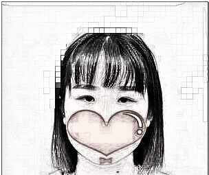南京施尔美赵鹏做的双眼皮_附手术后恢复分享