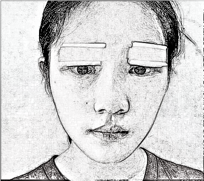 东莞韩美王仁斌做双眼皮好不好?介绍分享