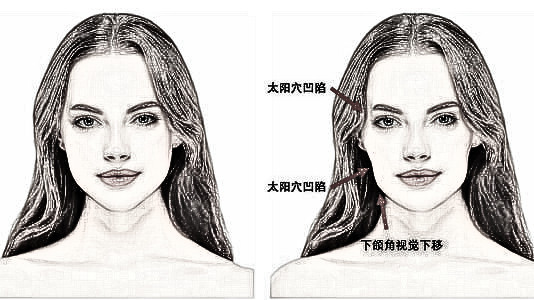 成都丰太阳穴 气质满满美丽无“下陷”