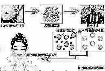 温州苍南人民医院自体脂肪面部填充面部怎么样