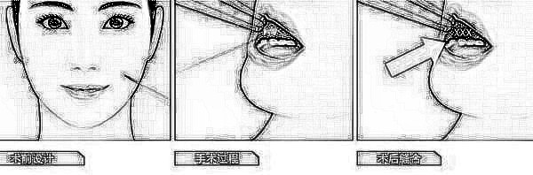 北京伊美康酒窝成形术 带动笑容的美丽