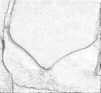 西安美莱找王鹏做自体脂肪隆胸怎么样？附介绍展示