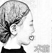 北京英煌医疗美容医院王良发医生鼻部手术记录分享，介绍实图查看