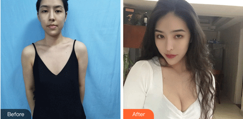 北京叶子整形鲁礼新隆胸怎么样?介绍果来查看!