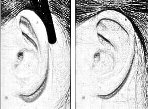 耳朵整型要多少钱？