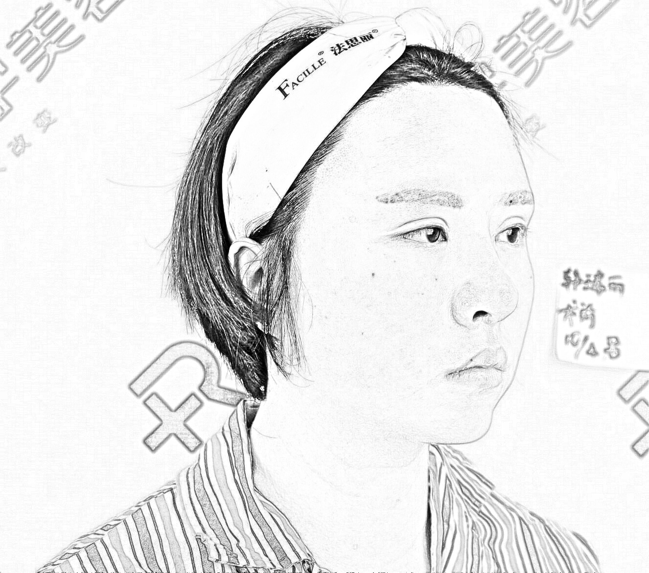 红妆尚整形膨体垫下巴介绍，图片直击术后果！