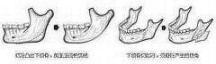 深圳米兰柏羽磨下颌角整形的果 如何避免