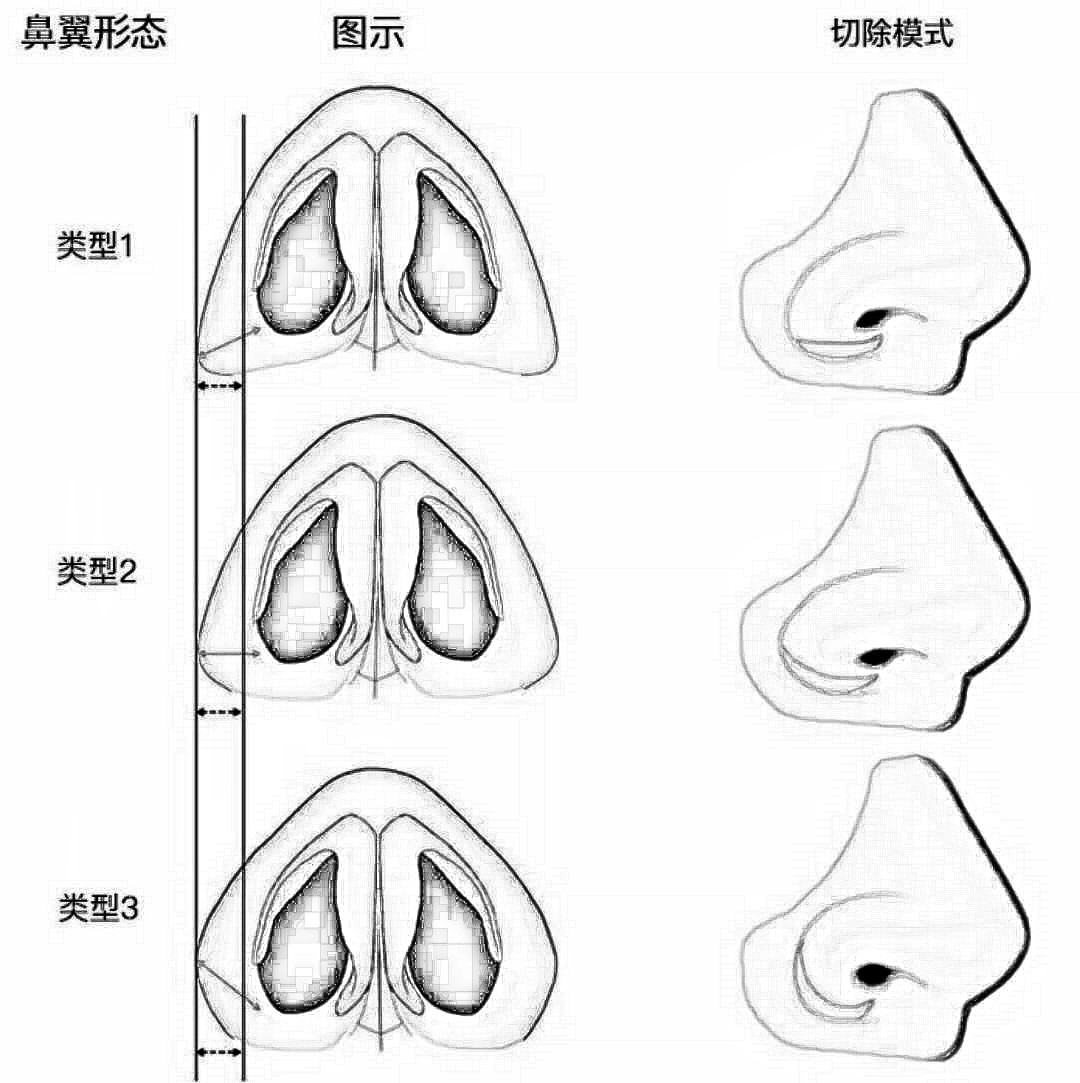 鼻子肥大怎么变小?