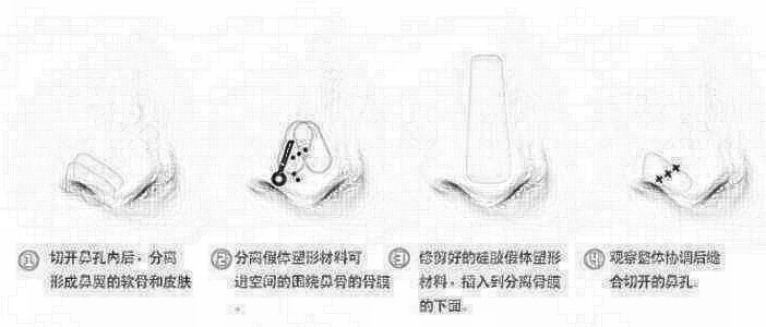 鼻子有点歪怎么办？