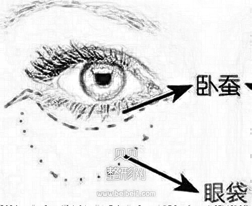 去眼袋需要多少钱呢?