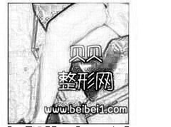 珠海华美医院做大腿吸脂介绍 秀出细长的小腿附加照片