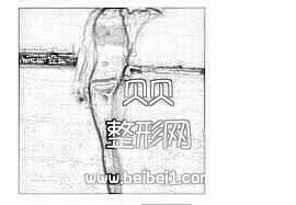 珠海华美医院做大腿吸脂介绍 秀出细长的小腿附加照片
