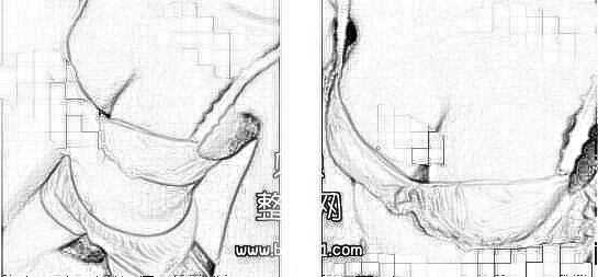 广州华美整形陈宁水滴型假体隆胸介绍 今天跟大家分享我的心得了