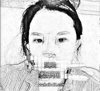 深圳希思医院分享隆鼻介绍 李俊医生技术精湛风格自然