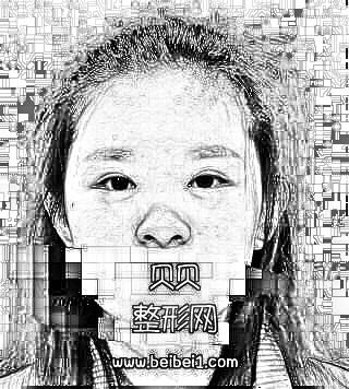 深圳希思医院分享隆鼻介绍 李俊医生技术精湛风格自然