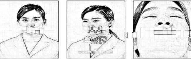 四川美莱整形做肋软骨隆鼻介绍 反馈一下我变美的样子 附加照片