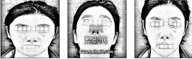 袁玉坤自体脂肪填充面颊介绍分享 现在恢复的很好了,脸也没有肿的情况