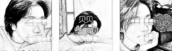 袁玉坤自体脂肪填充面颊介绍分享 现在恢复的很好了,脸也没有肿的情况
