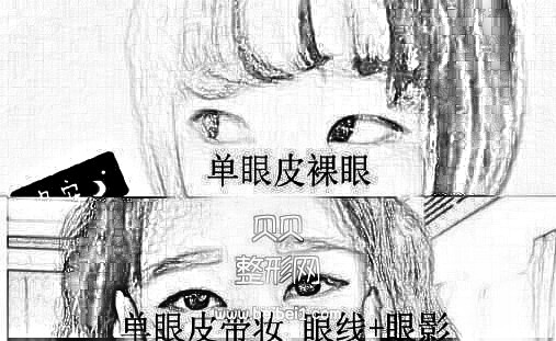 潍坊医学院整形外科医院牟少春医生做的双眼皮+开眼角 来看看吧