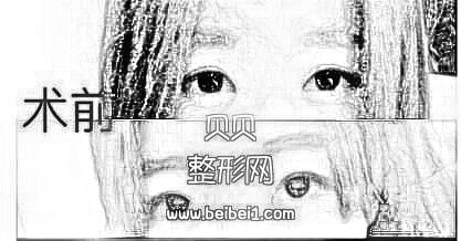 武汉同济医院王海平割双眼皮介绍分享~在线预约
