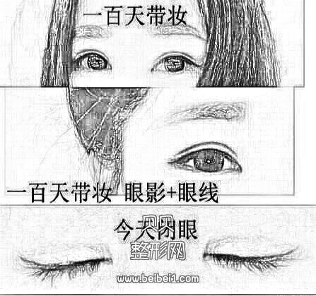 潍坊医学院整形外科医院牟少春医生做的双眼皮+开眼角 来看看吧