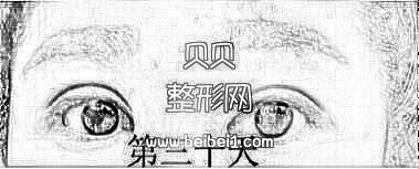潍坊医学院整形外科医院牟少春医生做的双眼皮+开眼角 来看看吧